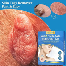 Skin Tag Remover Kit 2 in 1 for Micro to Large (2 mm - 8 mm / 1 Set) the24kgal
