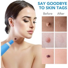 Skin Tag Remover Kit 2 in 1 for Micro to Large (2 mm - 8 mm / 1 Set) the24kgal
